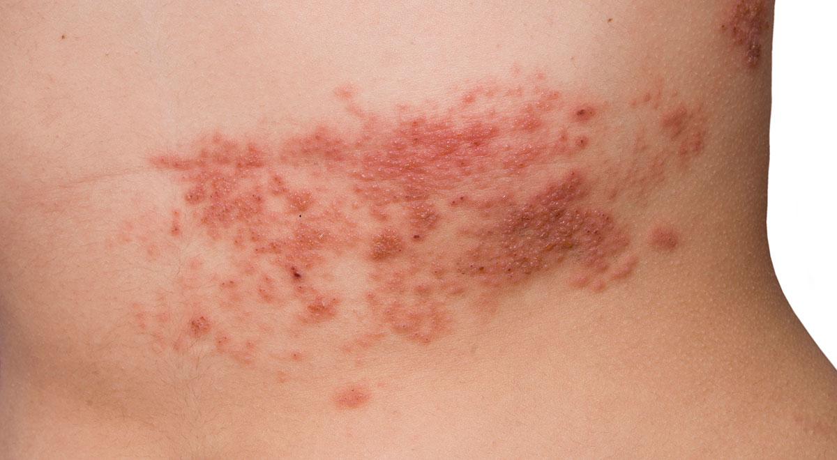 Taking Zostavax For Shingles? The CDC Says You Should Take Something Different