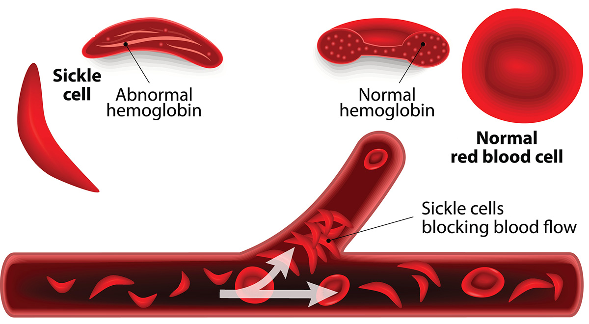 A New Drug in Development Could Help Patients With Sickle-Cell Anemia – But a Legacy of Racism Has Caused Delays